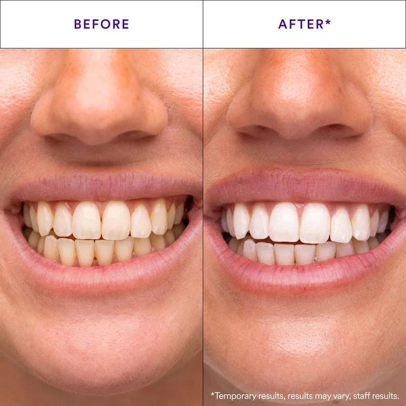 Teeth Whitening Strips