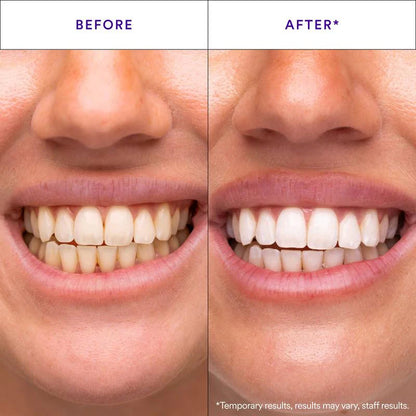 Teeth Whitening Strips